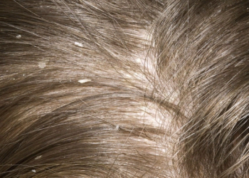 Recipe against dandruff and hair loss.