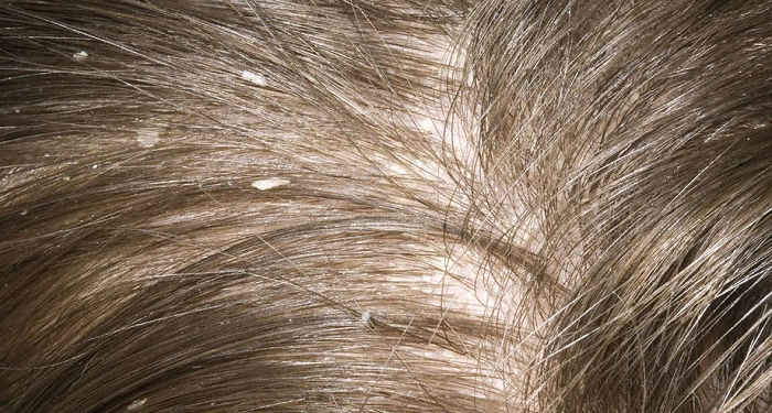 Recipe against dandruff and hair loss.