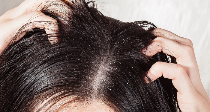 Recipe against dandruff and hair loss.